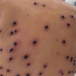 Alerta contínuo: Brasil registra 140 infecções por Mpox no início de 2026 sem letalidade