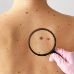 O silêncio nos dados: a lacuna que mascara o avanço do câncer de pele no Brasil